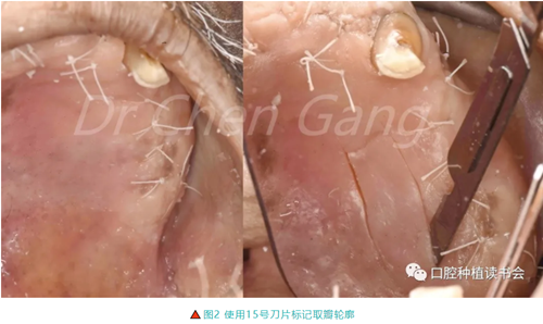 高清圖解｜游離牙齦（FGG）的獲取與移植技術