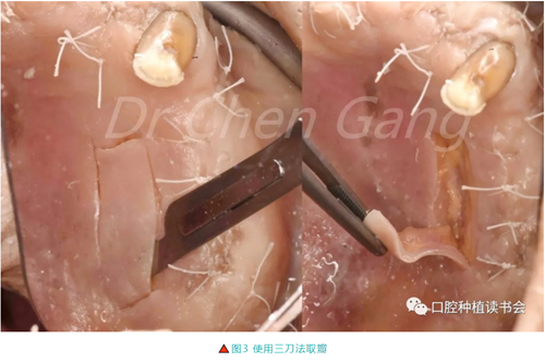 高清圖解｜游離牙齦（FGG）的獲取與移植技術