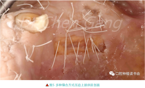 高清圖解｜游離牙齦（FGG）的獲取與移植技術