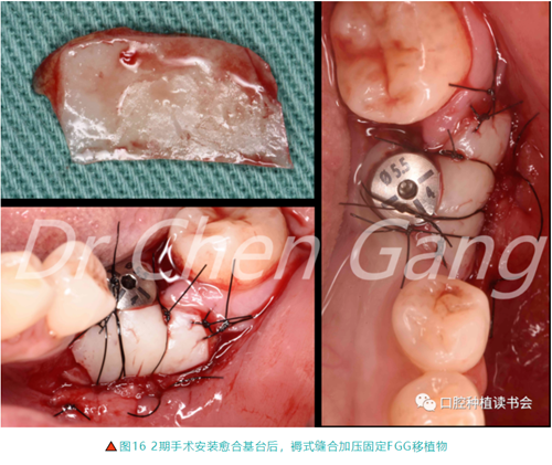 高清圖解｜游離牙齦（FGG）的獲取與移植技術