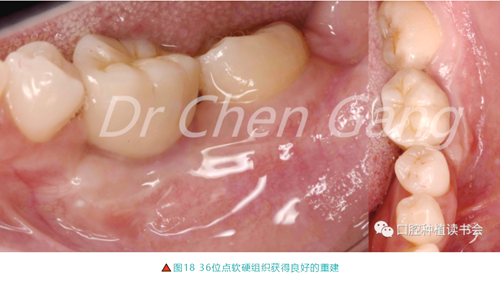 高清圖解｜游離牙齦（FGG）的獲取與移植技術