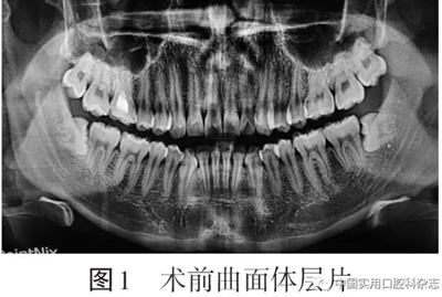 病例報告 | 下頜第三磨牙拔除術(shù)后并發(fā)雙側(cè)廣泛性皮下氣腫及縱隔氣腫1例報告