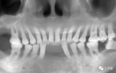 【病例分享】應用全程數字化對牙周炎患者實現全口即刻種植即刻修復