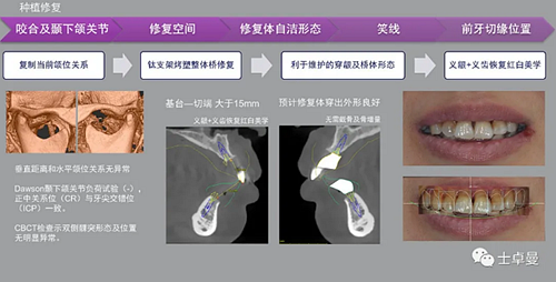 【病例分享】應用全程數字化對牙周炎患者實現全口即刻種植即刻修復