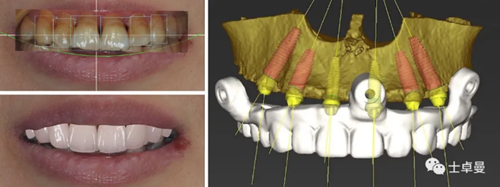 【病例分享】應用全程數字化對牙周炎患者實現全口即刻種植即刻修復