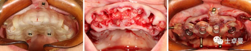 【病例分享】應用全程數字化對牙周炎患者實現全口即刻種植即刻修復