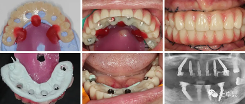 【病例分享】應用全程數字化對牙周炎患者實現全口即刻種植即刻修復