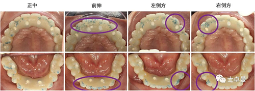 【病例分享】應用全程數字化對牙周炎患者實現全口即刻種植即刻修復