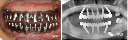 【病例分享】應用全程數字化對牙周炎患者實現全口即刻種植即刻修復