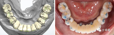 【病例分享】應用全程數字化對牙周炎患者實現全口即刻種植即刻修復