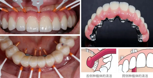 【病例分享】應用全程數字化對牙周炎患者實現全口即刻種植即刻修復