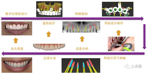 【病例分享】應用全程數字化對牙周炎患者實現全口即刻種植即刻修復