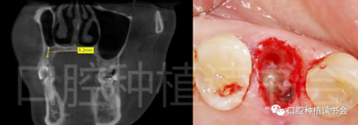 后牙區(qū)即刻種植臨床指南