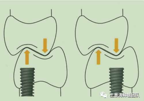 后牙區(qū)即刻種植的適應(yīng)癥的思考