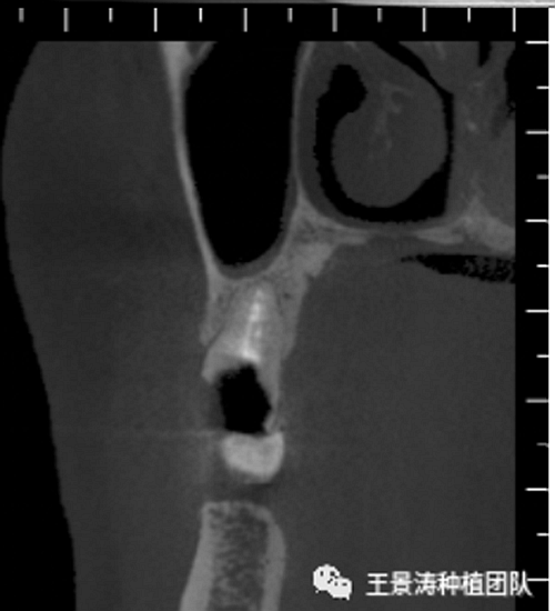 后牙區(qū)即刻種植的適應(yīng)癥的思考